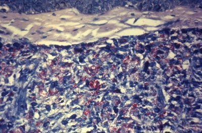 Histopathology of leprosy lesion