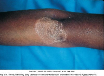Tuberculoid leprosy lesion