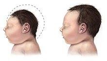 Comparison of baby with microcephaly and healthy baby