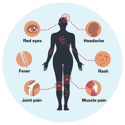 Symptoms of Zika virus infection