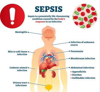 Infographic showing causes and symptoms of sepsis