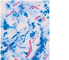 Acid-fast stain results