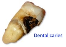 Dental caries caused by biofilm
