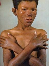 Leprosy affecting the skin and nerves
