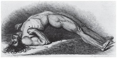 Opisthotonos: severe muscle spasm in tetanus