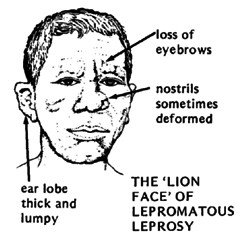 Lion face of lepromatous leprosy