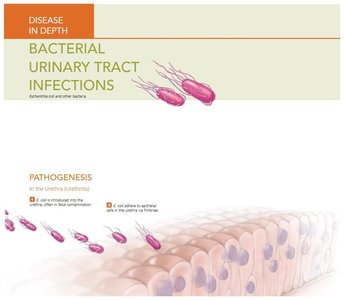 Bacterial Urinary Tract Infections: Pathogenesis 1