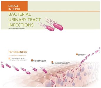 Bacterial Urinary Tract Infections: Pathogenesis 3