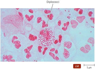 Diplococci of Neisseria Gonorrhoeae