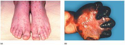 Petechiae in Meningococcal Septicemia