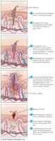 Overview of the events in inflammation following a cut and infection