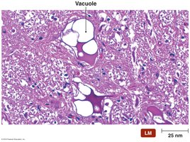 A brain showing the large vacuoles and spongy appearance typical in prion-induced diseases