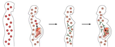 Diagram of Rh incompatibility and hemolytic disease of the newborn