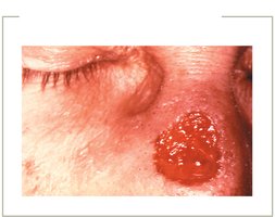 Tertiary syphilis gumma on face