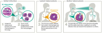 TB infection progression