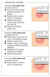 Mantoux test interpretation