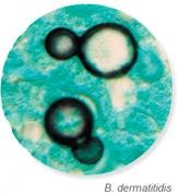 Blastomyces dermatitidis