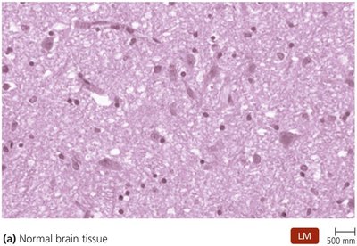 Normal brain tissue