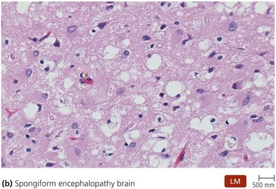 Spongiform encephalopathy brain tissue