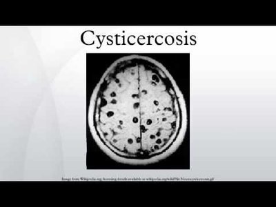 Cysticercosis in brain MRI
