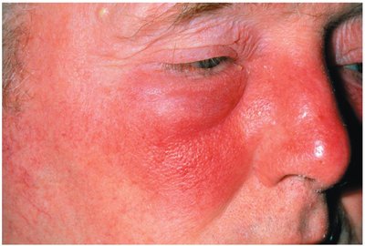 Erysipelas caused by Streptococcus pyogenes