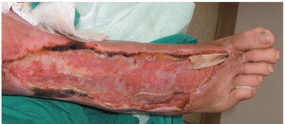 Necrotizing fasciitis caused by Streptococcus pyogenes