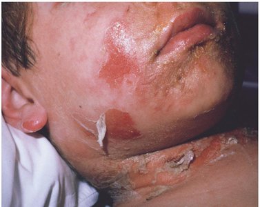 Scalded skin syndrome caused by Staphylococcus aureus