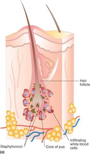 Diagram of a skin abscess caused by Staphylococcus aureus