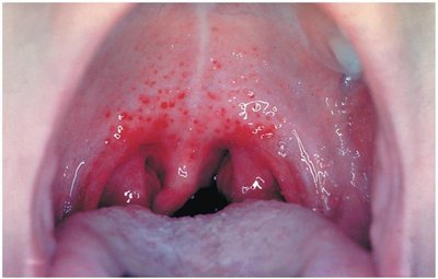 Strep throat caused by Streptococcus pyogenes