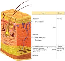 Cross-section of skin showing layers and associated diseases