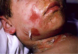 Severe SSSS with extensive skin sloughing