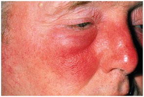 Erysipelas with red, swollen skin
