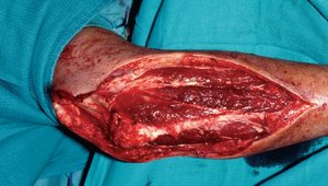 Necrotizing fasciitis with tissue destruction