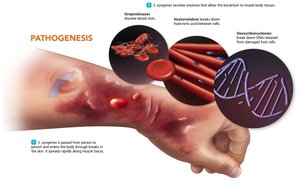 Pathogenesis of necrotizing fasciitis: enzymes and toxins