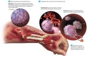 Further tissue damage in necrotizing fasciitis