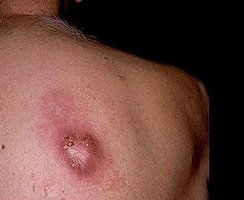 Furuncle (boil) on the skin