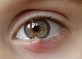 Sty at the base of the eyelid