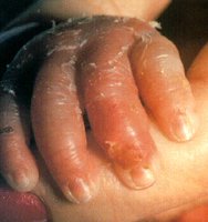 Blistering and peeling in SSSS