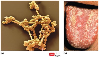 Candida albicans and oral candidiasis (thrush)