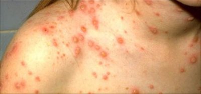 Chickenpox rash on skin