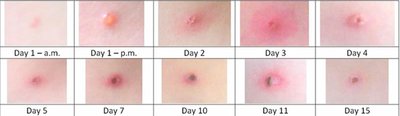 Progression of chickenpox lesion over days