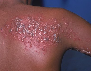 Shingles rash on back