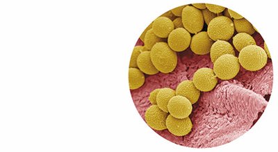Tinea pedis (athlete's foot)