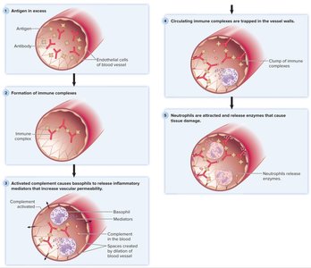 Steps in immune complex–mediated hypersensitivity