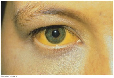 Jaundice in hepatitis B infection