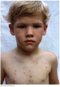 Characteristic chickenpox lesions