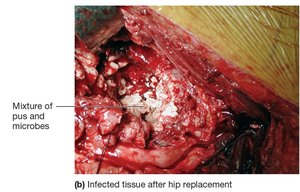 Infected tissue after hip replacement with biofilm