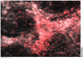 Pseudomonas aeruginosa biofilm in sputum