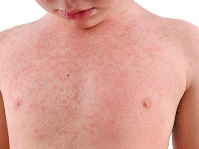 Meningococcal rash on chest