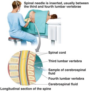 Spinal tap procedure for collecting cerebrospinal fluid